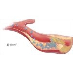 Plaque Rupture and Inflammation