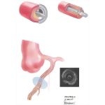 Intravascular Ultrasound