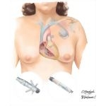 Implantable Cardiac Pacemaker