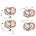 Percutaneous Aortic Valve Replacement