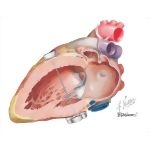 Atrial Septal Defect