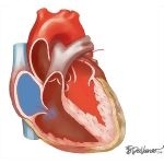 Summary of Doppler Findings In Restrictive Cardiomyopathy