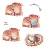 Coronary Sinus Devices for Mitral Regurgitation