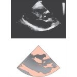 Tetralogy of Fallot