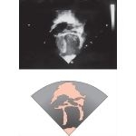 Pulmonary Atresia