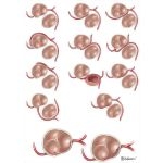 Anomalous Aortic Origin of Coronaries (AAOC)