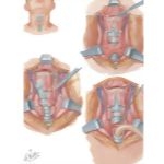Total Laryngectomy