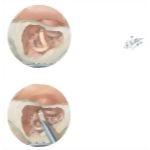 Ultrasonic Destruction of Vestibular Labyrinth