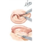 Ultrasonic Destruction of Vestibular Labyrinth