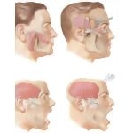 Muscle Plastic Operations for Facial Nerve Paralysis