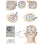 Additional Indications for Early Operations: Sinus Tears, Compound Depressed Fractures, and Penetration Injuries