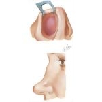 Nasal Fracture