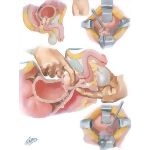 Surgical Approaches II - Retropubic
