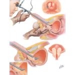 Surgical Approaches IV - Transurethral