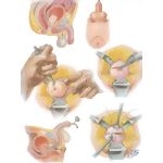 Surgical Approaches III - Perineal