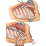 Chest Surgery In Tuberculosis