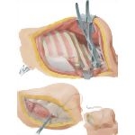 Chest Surgery In Tuberculosis