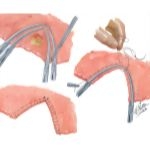 Chest Surgery In Tuberculosis