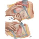 Chest Surgery In Tuberculosis