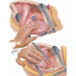 Chest Surgery In Tuberculosis