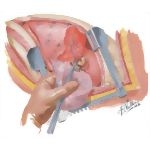 Chest Surgery In Tuberculosis