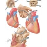Aortic Stenosis