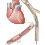 Coronary Artery Stripping