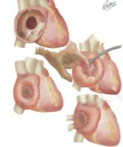 Atrial Septal Defect