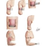 Amputations Of Upper Extremity