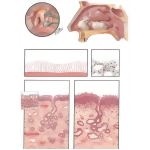 Acute And Chronic Nasal Allergy