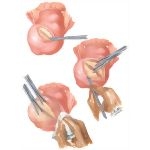 Myomectomy In Treatment Of Infertility