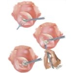 Myomectomy In Treatment Of Infertility