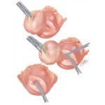 Myomectomy In Treatment Of Infertility