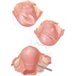 Myomectomy In Treatment Of Infertility