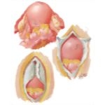 Myomectomy In Treatment Of Infertility
