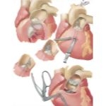 Pulmonic Stenosis