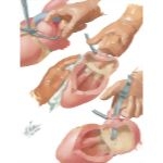 Left-Sided Approach To Mitral Stenosis