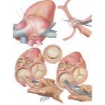Neostrophingic Mobilization, Right-Sided Approach