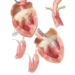 Subvalvular Stenosis