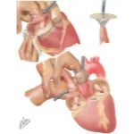 Tricuspid Stenosis