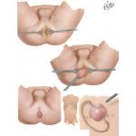 Perineal Approach To Imperforate Anus