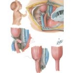 Transpleural Approach To Atresia Of Esophagus