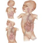 Transpleural Approach To Atresia Of Esophagus