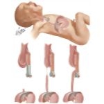 Various Forms Of Atresia Of Esophagus