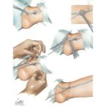 Catheterization Of Saphenous - View II