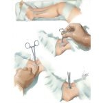 Catheterization Of Saphenous - View I