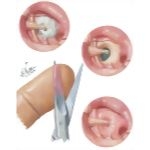 Otosclerosis - Vein Graft