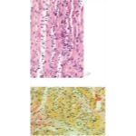 Viral Myocarditis