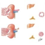 Renovascular Hypertension