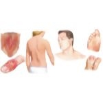 Common Bacterial Infections